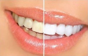  - Отбеливание зубов: домашние, аптечные и профессиональные способы