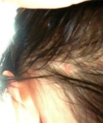 127872 Последствия наращивания волос: какой вред состоянию головы могут нанести неудачное ленточное и плохое капсульное удлинение, а также фото до и вслед за снятием - Особые ситуации